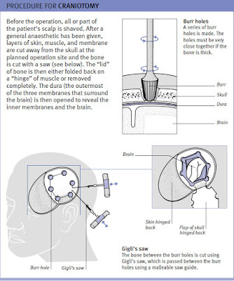 Procedure For Craniotomy