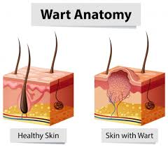 Two samples showing healthy skin and skin with warts