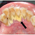 Nguyên nhân, tác tại và cách xử lý cao răng hiệu quả