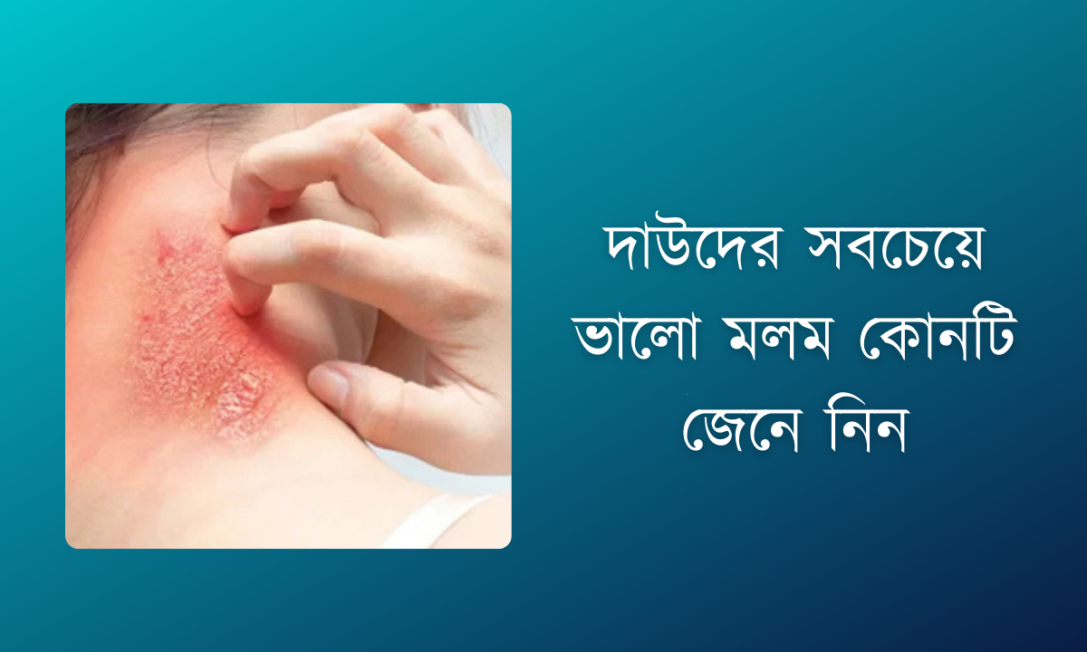দাউদের সবচেয়ে ভালো মলম কোনটি জেনে নিন