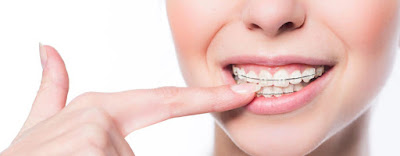 Niềng răng móm như thế nào an toàn và hiệu quả? 3