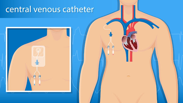 U.S. CENTRAL VENOUS CATHETER MARKET