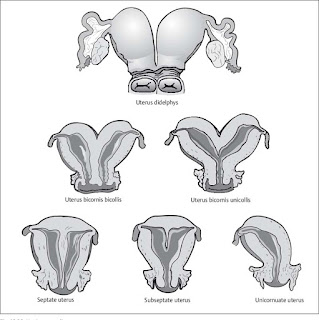   uterus bicornis, bicornuate unicollis uterus, bicornuate bicollis uterus, bicornuate uterus pregnancy, bicornuate uterus treatment, bicornuate uterus causes, bicornuate uterus symptoms, bicornuate uterus pregnancy pictures, partial bicornuate uterus