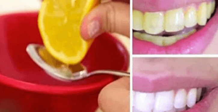 Look At Your Teeth Whitening With This Home Remedy