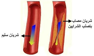 علاج الشرايين بالطب البديل