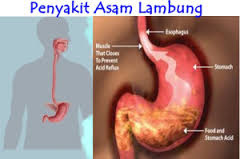 Nama Obat Herbal Asam Lambung Naik Yang Ampuh Dan Aman