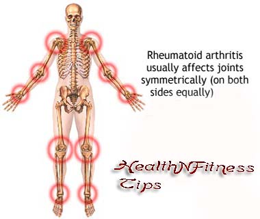 Health Tips to Identify the Psoriatic Arthritis