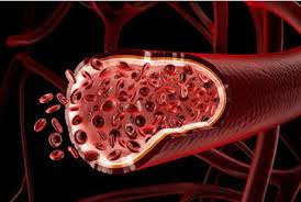 Mengenal Penyakit Pembuluh Darah dan Penyebabnya