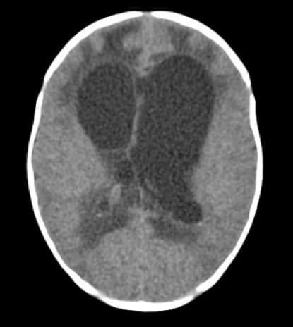 CT scan, showing marked hydrocephalus in infant with setting-sun eye phenomenon