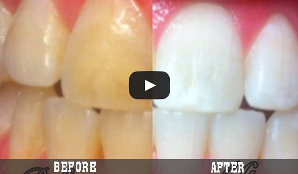 Teeth Whitening At Home In 3 Minutes