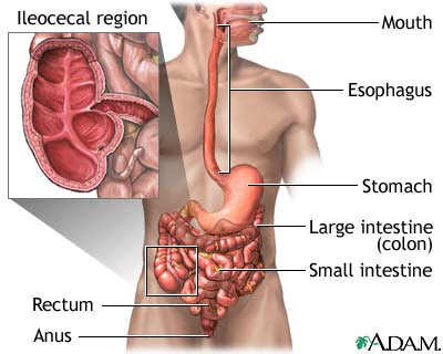 Crohn's Disease