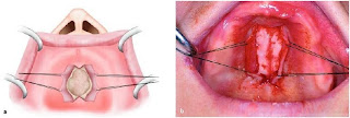 Torus Removal Surgery