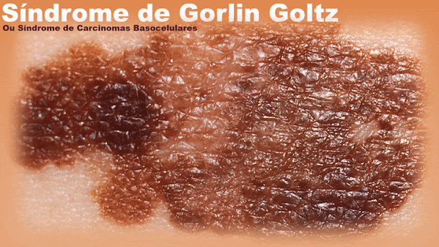 Síndrome de Gorlin Goltz | Síndrome de Carcinomas Basocelulares
