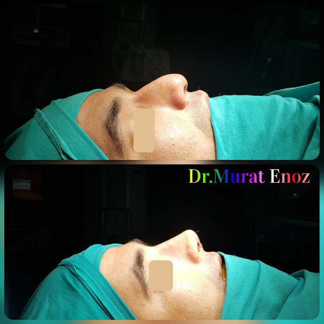 Thick Skinned Male Rhinoplasty Turkey, Nose Job For Men Istanbul, Droopy Nose Aesthetic For Men