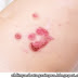 5 Tips Mengobati Impetigo Secara Menyeluruh