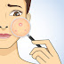 10 Causes of Acne