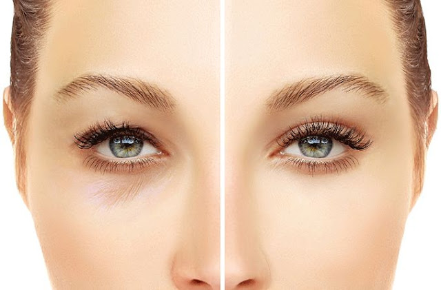 eyelid surgery in Turkey