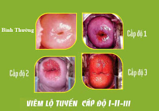 viem-lo-tuyen-co-tu-cung-nguyen-nhan-trieu-chung-cach-dieu-tri