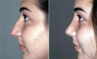Nose Before And After