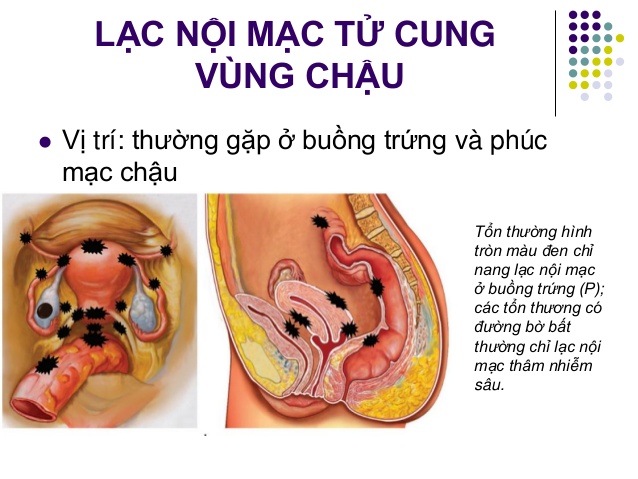 chẩn đoán lạc nội mạc tử cung bằng siêu âm