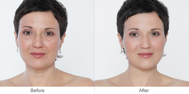 Before and After Dermal Filler Treatment