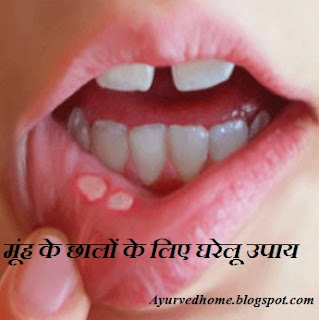 मुहँ के छाले होने पर क्या करे, Mouth Ulcer  Home Remedies in Hindi , muh ke chhalon ka gharelu ilaj, muh ke chale, मूंह के छालों के लिए घरेलू उपाय, 