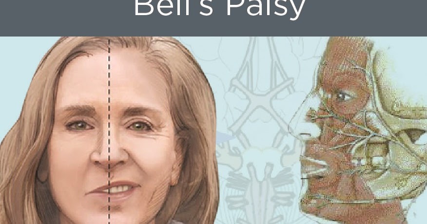 Cara Menyembuhkan Bell s Palsy Secara Cepat Jelly Gamat Cara Menyembuhkan Bell s Palsy Secara Cepat Jelly Gamat