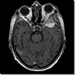 Meningioma-Commons