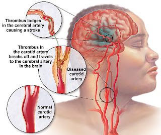 Jus Untuk Stroke