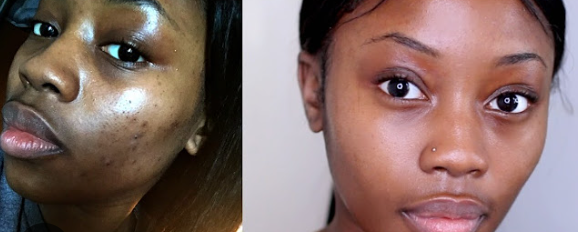 Hormonal Acne Skincare Routine for Black Skin: Expert tips