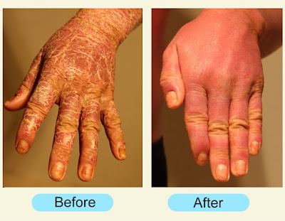 Psoriasis on hand Pictures