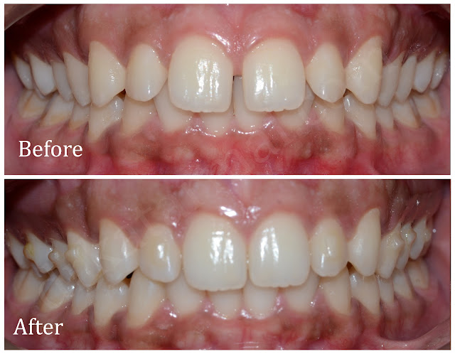 Orthodontic Treatment with Clear Removable Aligner at Jamnagar
