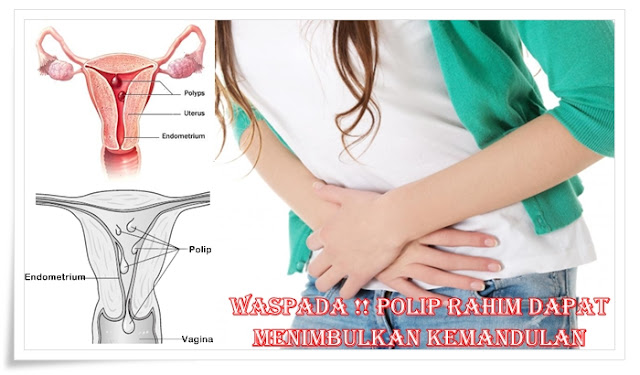 Pengobatan Herbal Polip Rahim Secara Alami