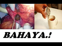 SEBELUM TERLAMBAT !!! INI BAHAYANYA JIKA KAMU PUNYA KEBIASAAN MINUM TEH HANGAT DI CAMPUR DENGAN SU*SU ... BANTU SEBARKAN INFO PENTING INI TANDA PEDULI SESAMA SATU KALI BERBAGI BERARTI ANDA TELAH MENYELAMATKAN BANYAK NY4WA !!!