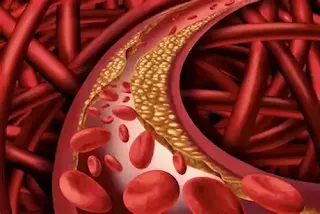 Top Warning Signs of High Cholesterol in 2025 (Plus Science-Backed Prevention Tips!)