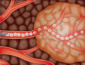 Embolization