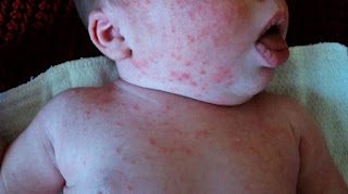 How to Distinguish and Treat Baby Acne on Chest