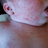 How to Distinguish and Treat Baby Acne on Chest