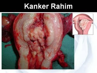 obat alternatif kanker serviks, obat kanker serviks, pengobatan alternatif kanker serviks