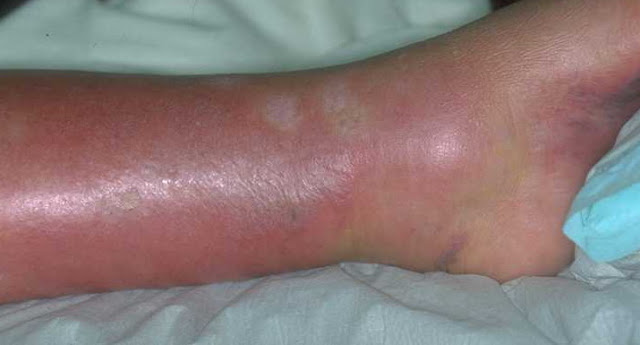 Is erysipelas contagious - Erysipelas vs. Cellulitis