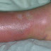 Is erysipelas contagious - Erysipelas vs. Cellulitis