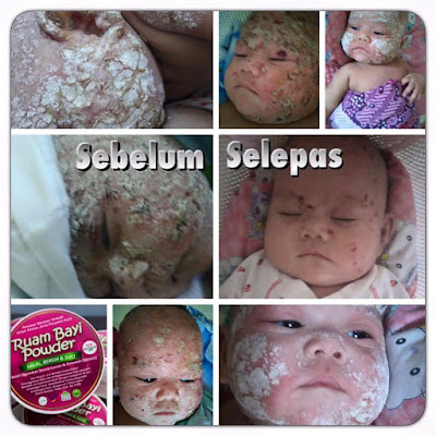 penawar-psoriasis-untuk-bayi