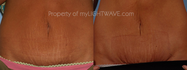 to prevent stretch marks. 2011