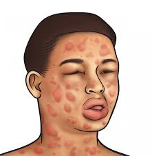 allergic shock,anaphylaxis causes,allergic shock syndrome