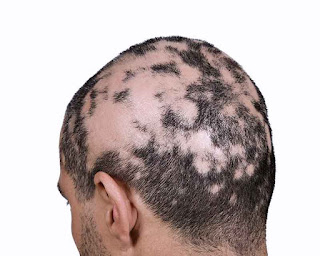 ¿Qué Es La Alopecia Areata