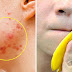 Use Banana Peel 2 Times A Day And Remove Acne Within 7 Days!