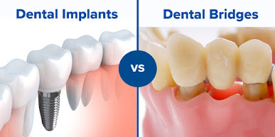 Dental Implants Or Bridges