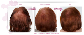 Keranique Hair Regrowth Treatment