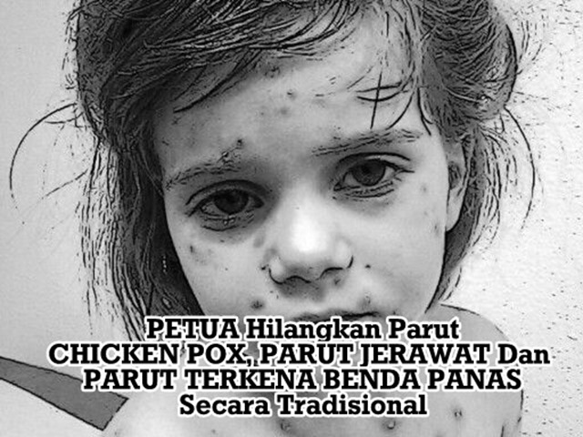 PETUA HILANGKAN PARUT CHICKEN POX, PARUT JERAWAT DAN PARUT TERKENA BENDA PANAS SECARA TRADISIONAL