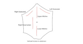 : Upper and lower median , Kocher , left subcostal , Right paramedian